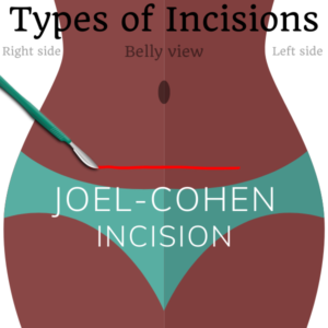 Joel Cohen incision for female sterilization surgical incisions