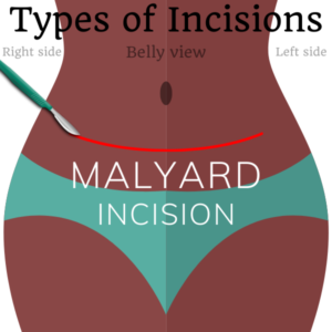 Maylard incision female sterilization surgical incisions