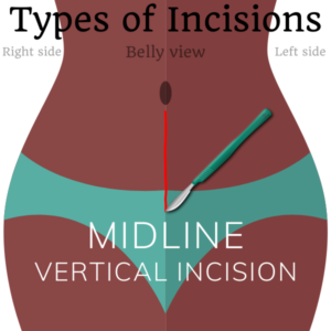 Midline vertical incision sterilization surgical incisions