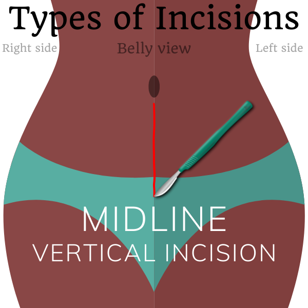 Midline Abdominal Incision