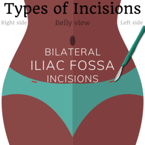 bilateral iliac fossa incisions female sterilization
