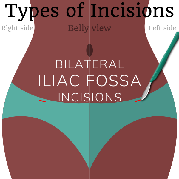 Room Incision Types of surgical incisions - SterilizationAunty