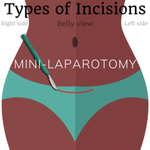 mini laparotomy incision