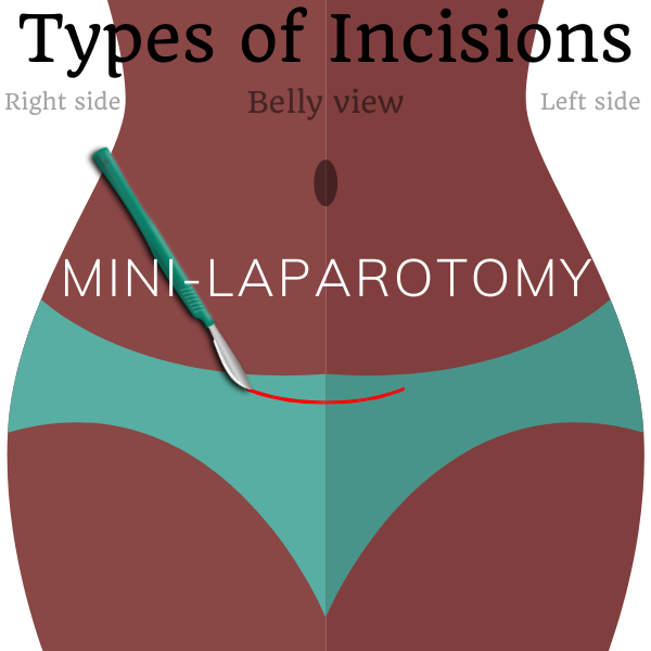 types-of-surgical-incisions-sterilizationaunty