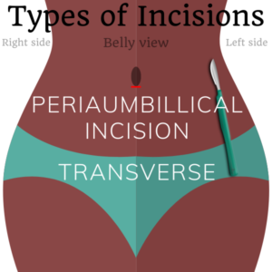female sterilization periumbilicalincision transverse