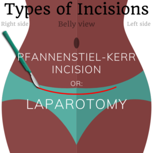 pfannenstiel kerr incision laparotomy