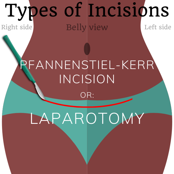 Mini Laparotomy Incision Types of surgical incisions - SterilizationAunty