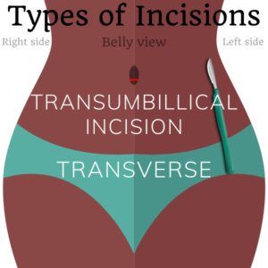 transumbilical incision transverse female sterilization