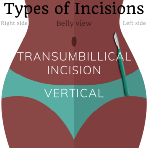 transumbilical incision vertical female sterilization