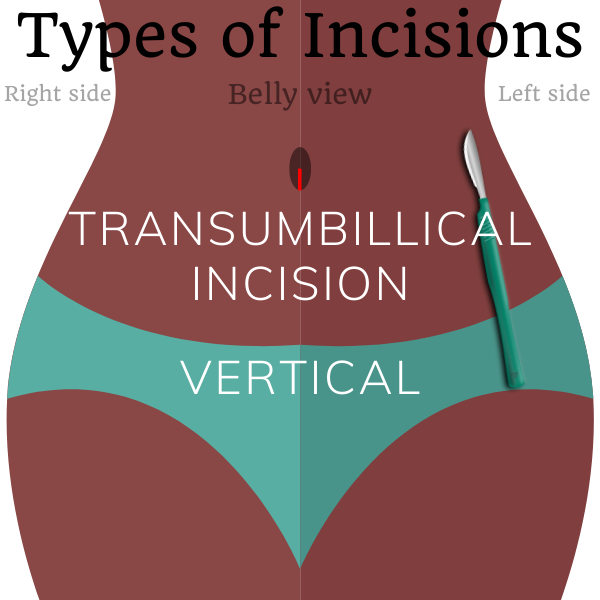 Types Of Surgical Incisions SterilizationAunty