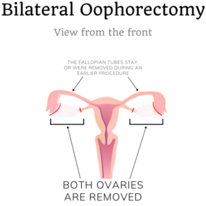 bilateral oophorectomy schematic sterilization aunty