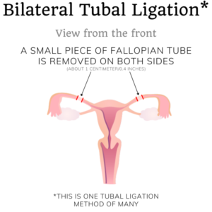 bilateral tubal ligation schematic sterilization aunty