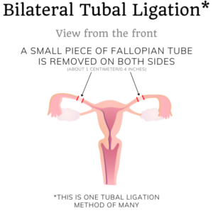 tubal ligation bilateral sterilization types female procedures btl