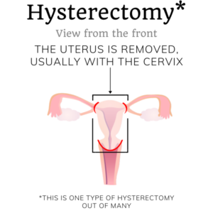 total hysterectomy schematic sterilization aunty